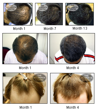 Male-hair-loss-3-Beforeafters