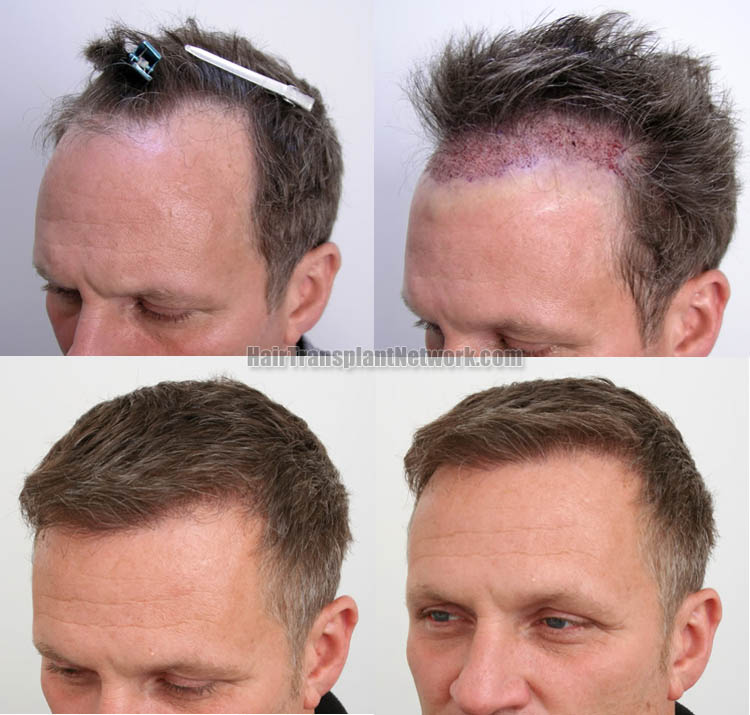 hair-transplant-surgery-photos-left-157998