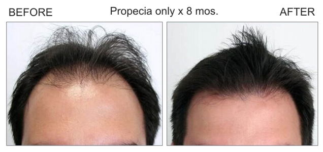 finasteride before and after temples