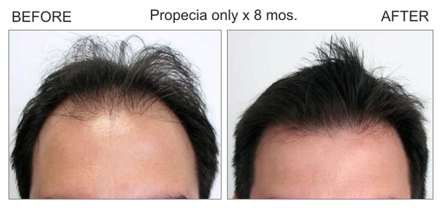 propecia-8-mos